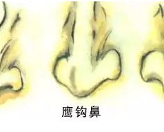 西安隆鼻：鹰钩鼻能矫正吗,效果怎么样？
