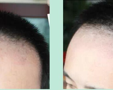 西安植发:头发移植术前需注意什么事项?