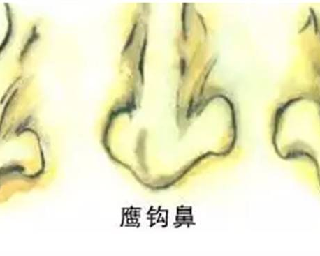 西安隆鼻：鹰钩鼻能矫正吗,效果怎么样？