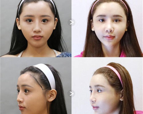 西安植发哪个医院效果比较好